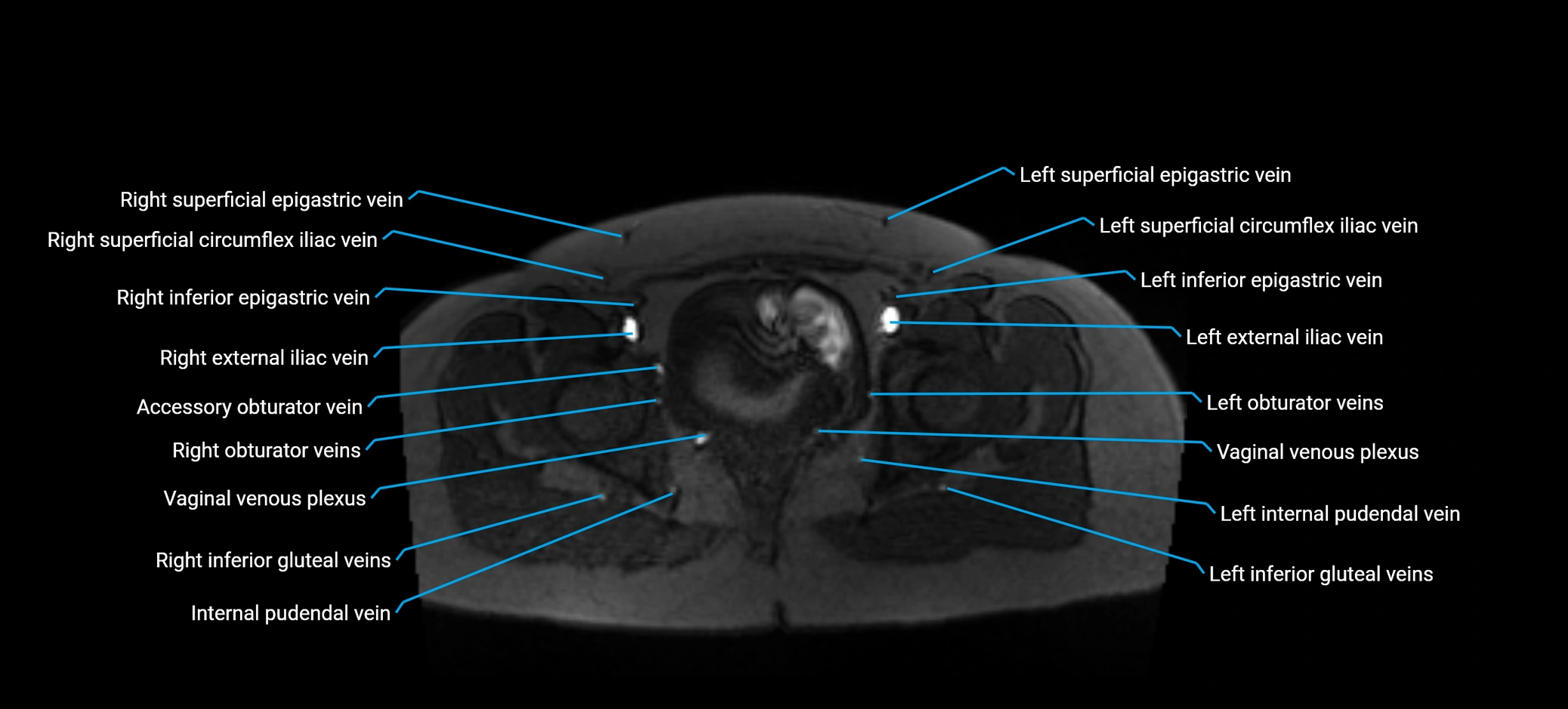 MRV abdomen pelvis & lower limb axial cross sectional anatomy labelled MRI image 178 (1).webp